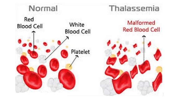 Thalassemia