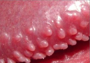 পার্লি পেনাইল প্যাপিউলস - pearly penile papules