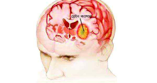 ব্রেইন ক্যান্সার কি? Brain Cancer