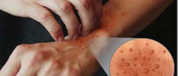 একজিমা হওয়ার কারন ও রোধের উপায় Xima Hoyar Karon o Rodher Upai