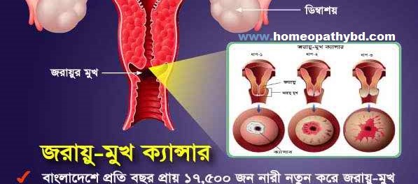 জরায়ু ক্যান্সারের কথা Jorayu Cancer Bangla Helth Tips