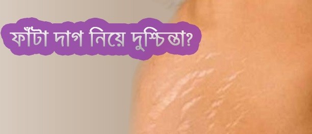শরীরের ফাটা দাগ বা স্ট্রেচ মার্ক নির্মূল করুন সহজ ১০টি উপায়ে | Shorirer Fata Dag Ba Strece Nirmul Korar Upai